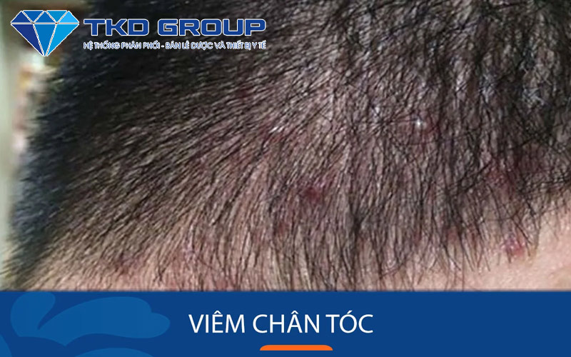 benh-viem-chan-toc