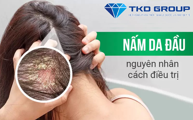nguyen-nhan-cua-nam-da-dau-gay-rung-toc