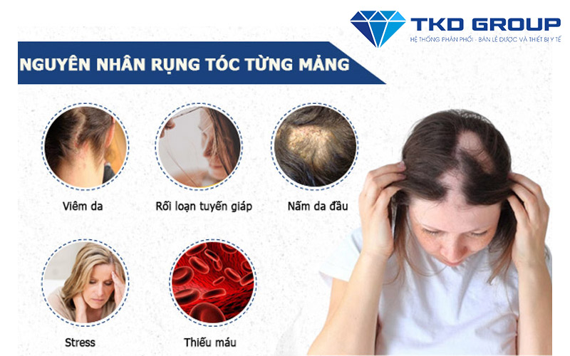 nguyen-nhan-rung-toc-tung-mang