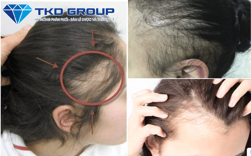 rung-toc-do-keo-Traction-alopecia