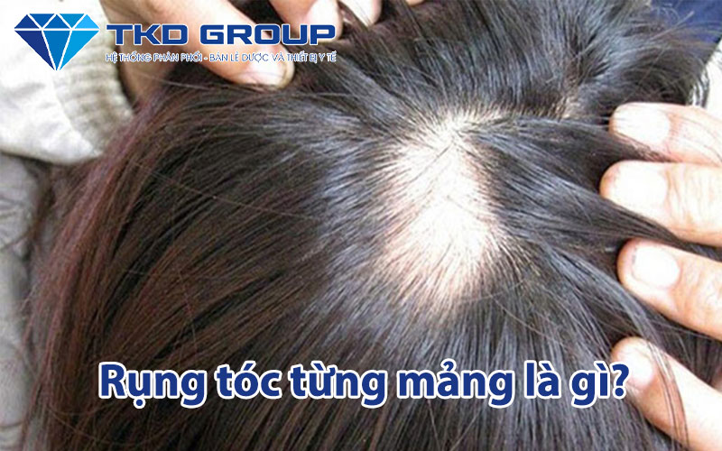 rung-toc-tung-mang-la-gi