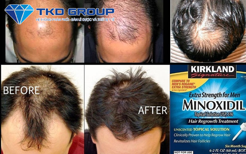 thuoc-boi-moc-toc-Minoxidil