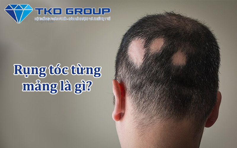 tinh-trang-rung-toc-tung-mang-la-gi