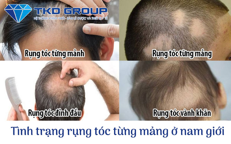 tinh-trang-rung-toc-tung-mang-o-nam-gioi