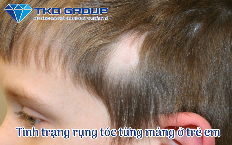 tinh-trang-rung-toc-tung-mang-o-tre-em