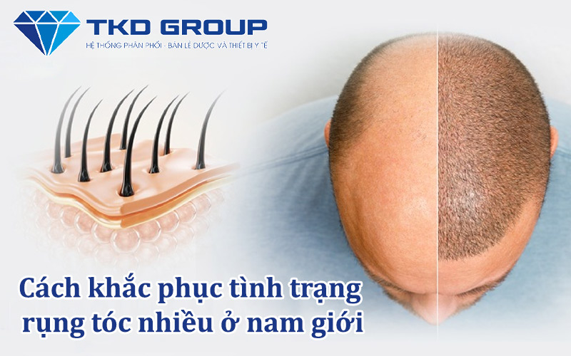 cach-khac-phuc-tinh-trang-rung-toc-nhieu-o-nam-gioi