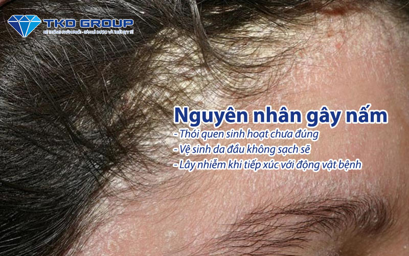 nguyen-nhan-gay-nam-da-dau