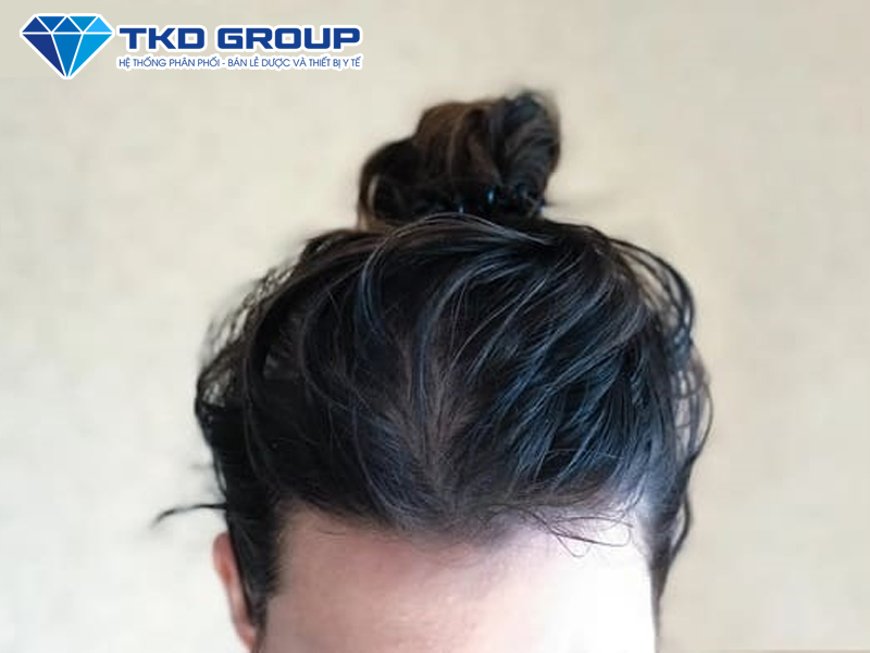 tóc bết dầu do buộc tóc quá chặt
